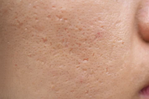 Aknenarben Behandlung Berlin