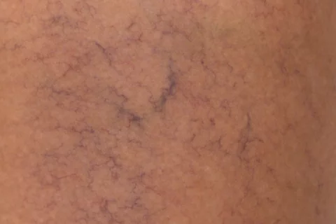 Besenreiser entfernen Berlin