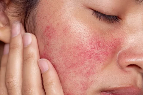 Couperose Behandlung Berlin