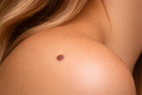 Muttermal entfernen Berlin