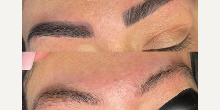 Vorher-Nachher-Ergebnis einer PMU-Augenbrauenentfernung nach einer Behandlung mit dem Pikosekundenlaser bei SKINTIME Berlin.