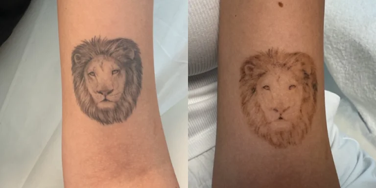 Vorher-Nachher-Ergebnis einer Tattooentfernung am Unterarm nach zwei Behandlungen mit dem Pikosekundenlaser enlighten von Cutera bei SKINTIME Berlin.