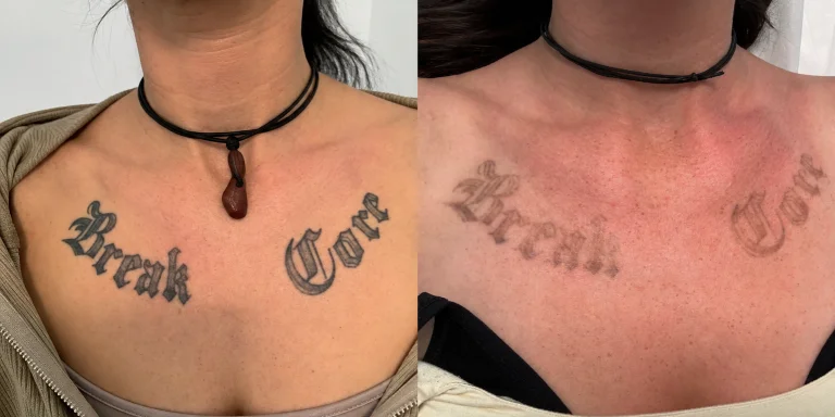 Vorher Nachher Tattooentfernung Schriftzug