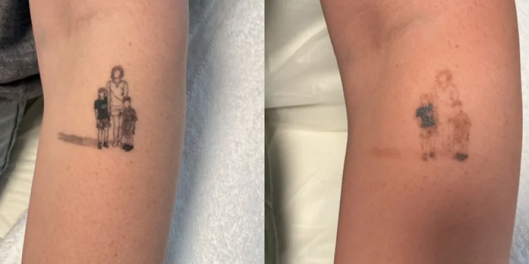 Vorher Nachher tattoo-removal